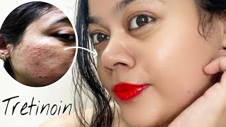 TRETINOIN Before amp After  My skin Transformation with Tretinoin pimple acnetreatment [upl. by Stanford962]