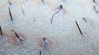 JUICY SATISFYING INGROWN HAIR PULL😍😍😍 [upl. by Eetsirhc709]