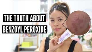 Clear Acne With Benzoyl Peroxide Pros and Cons [upl. by Dituri]