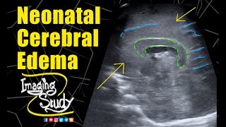 Neonatal Cerebral Edema  Ultrasound  Case 278 [upl. by Berfield]