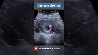 VESICULA VITELINA EMBARAZO DE 6 SEMANAS DE GESTACIÓN [upl. by Avat]