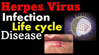 Herpes virus infection and treatment [upl. by Deutsch]