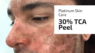 Platinum Skin Care 30 TCA demo vegan [upl. by Dulcinea]