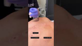 Mole Removal with Radiofrequency at StudioMD moleremovaltreatment [upl. by Ailemrac140]