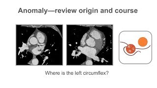 Abdominal Aortic Aneurysm Repair  Dr Robert Feezor MD FACS [upl. by Poulter323]