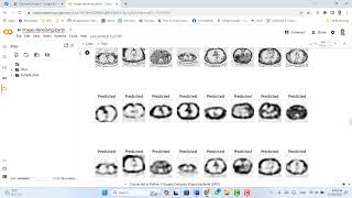 Project Denoising brain tumor using Autoencoder عربى [upl. by Eiduj]