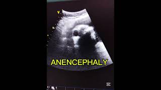 Anencephaly in ultrasound [upl. by Kcirdec]