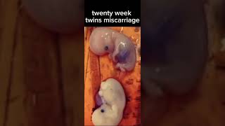 Twenty weeks twins miscarriage shortsviral viralvideo twins babies [upl. by Muirhead278]