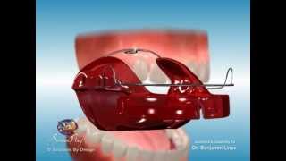 ScreenPlay Orthodontic Education Videos Bionator Appliance [upl. by Niletak]