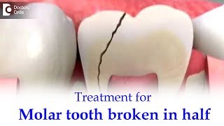 Back toothMolar tooth broke in half inside What to do  Dr Ranjani Rao  Doctors Circle [upl. by Aikmat]