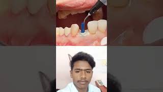 how to treat teeth drilldentistviralreels viralytshorts viralshortmedicaltrendingfillingtet [upl. by Emiline105]