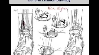 Tibial pilon fractures 2 [upl. by Durno]