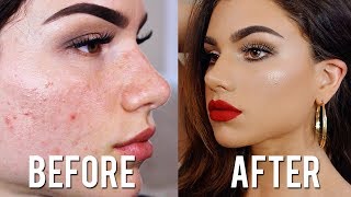 How To Cover ACNE amp SCARS with Makeup Full Coverage Foundation amp Concealer Tutorial [upl. by Lamson268]