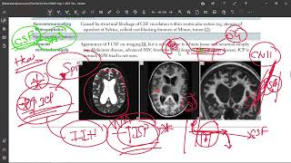 50 Idiopathic Intracranial Hypertension Pseudotumor Cerebri [upl. by Birgitta]