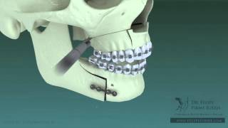 What is an Oral amp Maxillofacial Surgeon [upl. by Abelard]