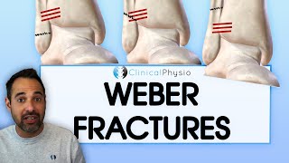 What is a Weber Ankle Fracture  What they are Key things to know and How they are managed [upl. by Franzen]