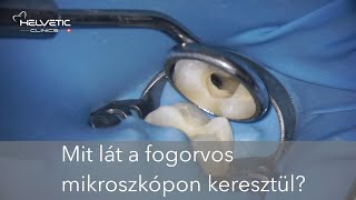 Mikroszkópos gyökérkezelés  mit lát a fogorvos kezelés közben [upl. by Leirbag]