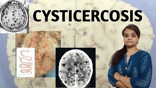 CYSTICERCOSIS [upl. by Dnomyad]