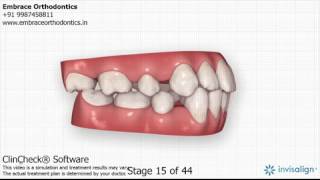 Extraction space closure with Invisalign India [upl. by Atsirtal]