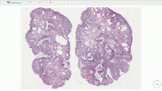 Juvenile polyp  Colon Histopathology [upl. by Alekim]