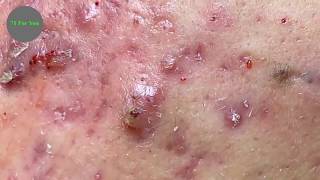 Espinillas Negras Enormes  Enormous Blackheads Extraction [upl. by Acinomad]