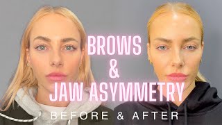 Asymmetrical Brows Fix Dr Nina Bals Solution for Asymmetrical Brows amp Jawline with Fae Williams [upl. by Naerda153]