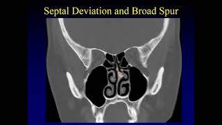 Imaging of the Paranasal Sinuses 2 [upl. by Casavant304]