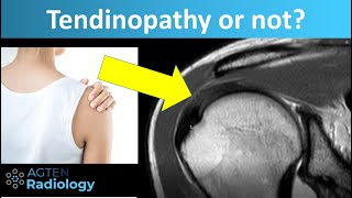 Tendinopathy Tendinosis of Rotator Cuff Tendons on MRI [upl. by Menzies67]