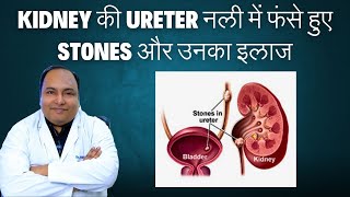 Kidney की Ureter नली में फंसे हुए stones और उनका इलाज [upl. by Freberg512]