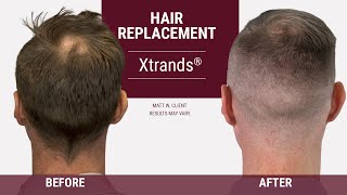 How to cover a bald spot on the back of your head Hair Replacement [upl. by Aihsekram]