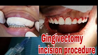 Gingivectomy incision procedure  gum cutting [upl. by Ennyletak307]