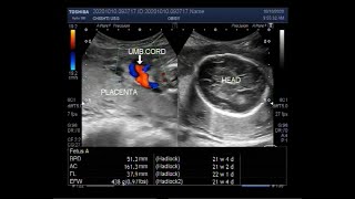 Waters Broken Explaining forewater amp hindwater membrane ruptures in pregnancy and birth [upl. by Edac]