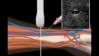 Anlage invasive arterielle Druckmessung [upl. by Hayman962]