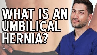 Umbilical Hernia  Everything You Need To Know [upl. by Sulamith]