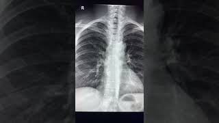 Right cardiophrenic angle opacity  Most common cause [upl. by Enicnarf524]