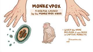 Monkeypox Explained [upl. by Ssidnac]