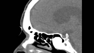 Chapter 1 Basic Sinus Anatomy [upl. by Cherey]