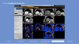 Philips IntelliSpace Portal 90 clinical application MR Cardiac [upl. by Notsa]