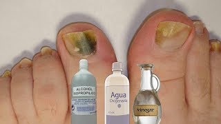 Fabrica tu propio “rompe hongos” natural para las uñas [upl. by Kirsch377]