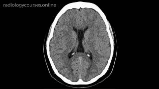 How to differentiate between a persistent cavum septum pellucidum or cavum vergae [upl. by Burner]