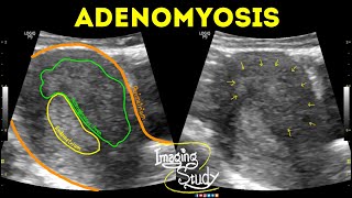 Adenomyosis  Ultrasound  Case 42 [upl. by Lairea]