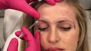 Botox Injections from low eyebrows lifting them up  by Dr Kassir [upl. by Laurel]