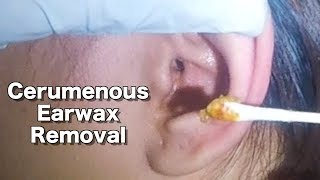 Girls Cerumenous Earwax Removal amp Ear Cleaning [upl. by Kowtko]