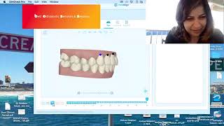 Invisalign Class II deep bite correction [upl. by Ecadnarb]