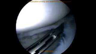 Arthroscopic quotsaucerizationquot menisectomy of Discoid Lateral Meniscus by Dr Mihir Patel Mumbai [upl. by Otreblide]