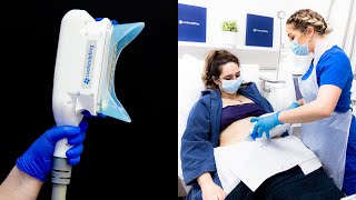 Is CoolSculpting worth it  Before and After Results [upl. by Perce]