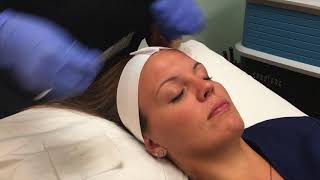 Dermaplaning and Chemical Peel Demonstration amp Results [upl. by Ahsienat973]