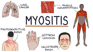 Understanding Myositis Polymyositis and Dermatomyositis [upl. by Adnylg995]