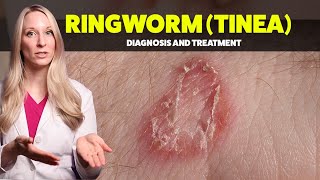 Ringworm Tinea  Diagnosis Treatments and Home Tips from a Dermatologist [upl. by Atikahs]