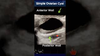 CT Scan Abdomen and Pelvis of Uterine Cancer [upl. by Nylinnej]